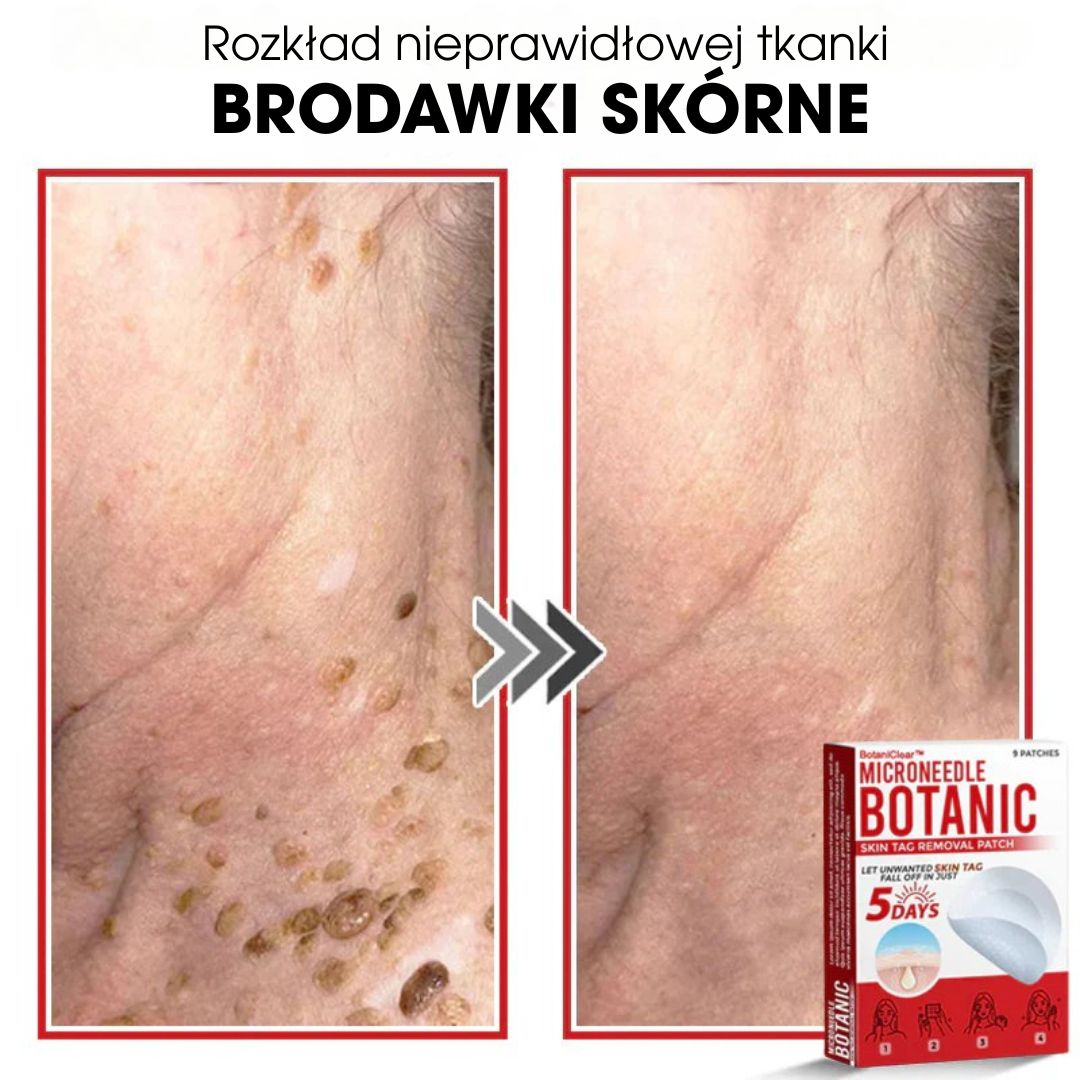 BotaniClear™ – Plaster z mikronakłuciami na zmiany skórne - 1+1 GRATIS