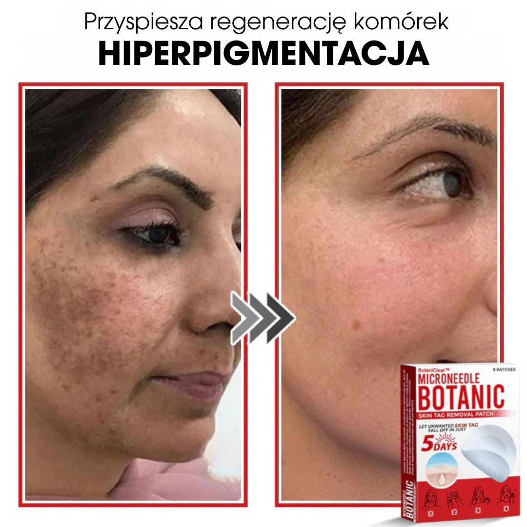 BotaniClear™ – Plaster z mikronakłuciami na zmiany skórne - 1+1 GRATIS