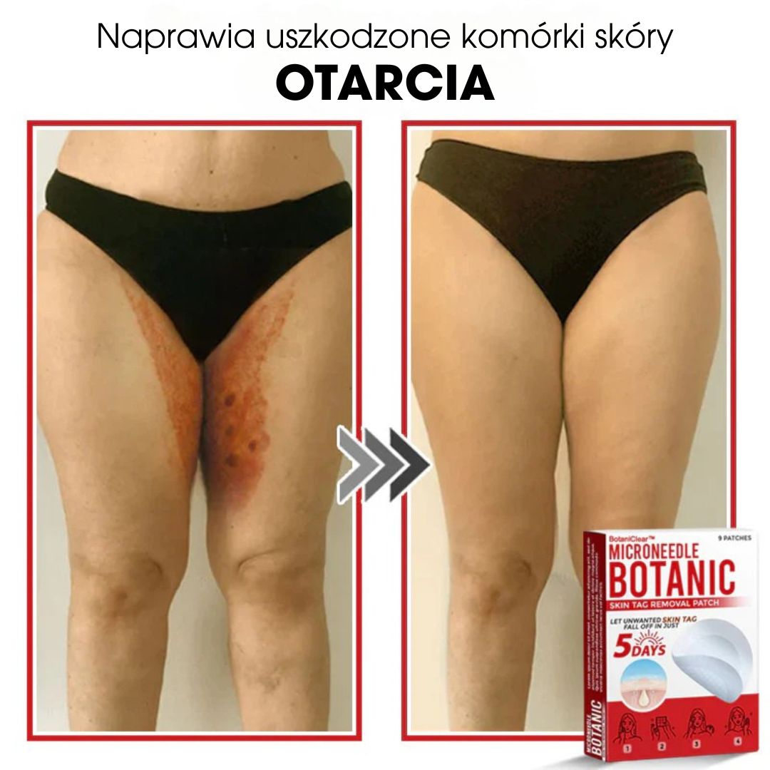 BotaniClear™ – Plaster z mikronakłuciami na zmiany skórne - 1+1 GRATIS