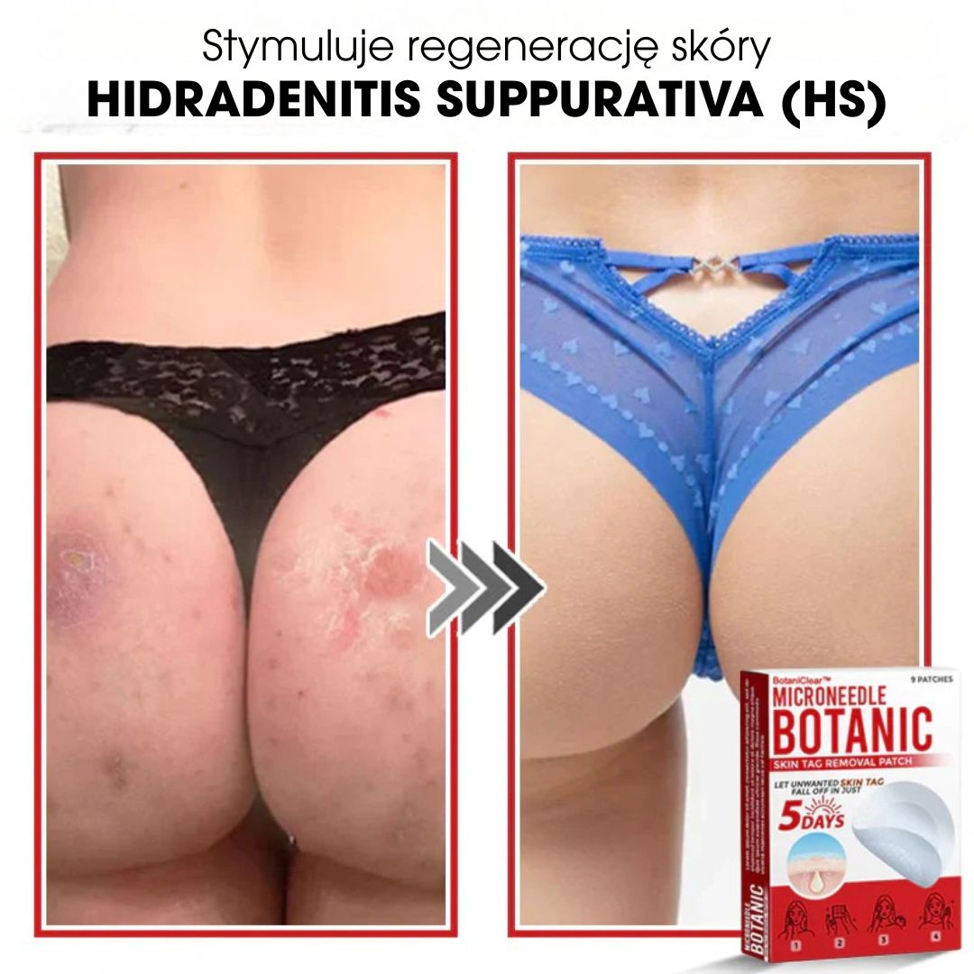 BotaniClear™ – Plaster z mikronakłuciami na zmiany skórne - 1+1 GRATIS
