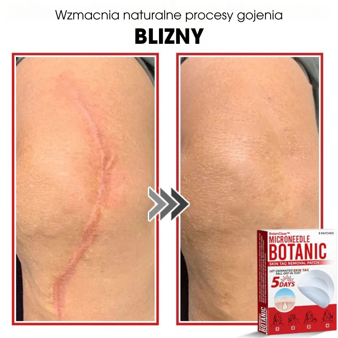 BotaniClear™ – Plaster z mikronakłuciami na zmiany skórne - 1+1 GRATIS