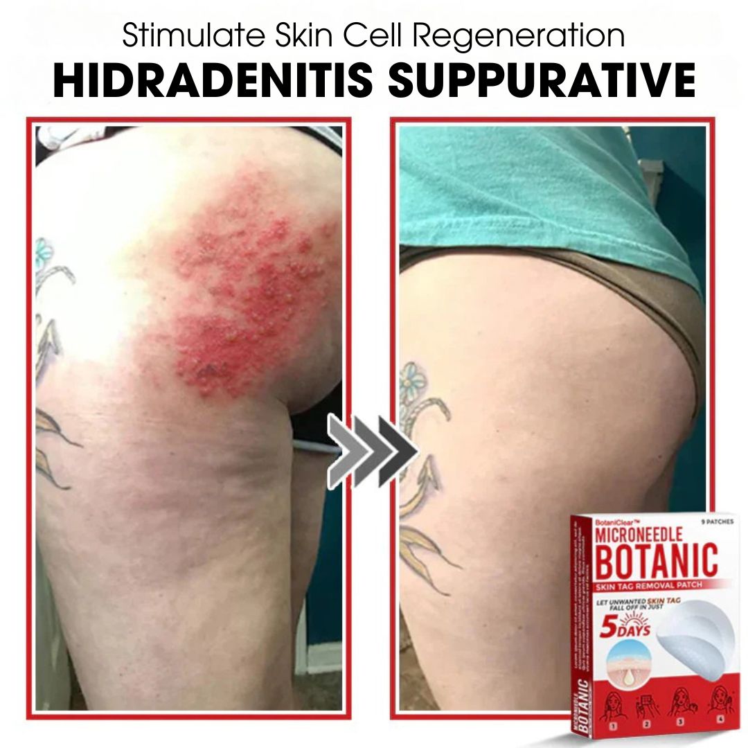 BotaniClear™ – Plaster z mikronakłuciami na zmiany skórne - 1+1 GRATIS