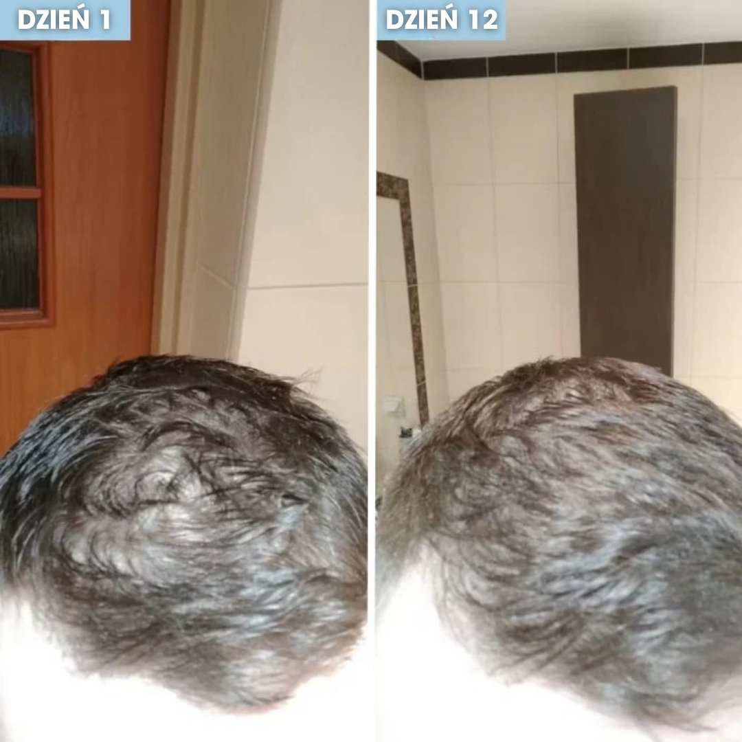 RootIgnite™ – Roll-on na natychmiastowy porost włosów - 1+1 GRATIS