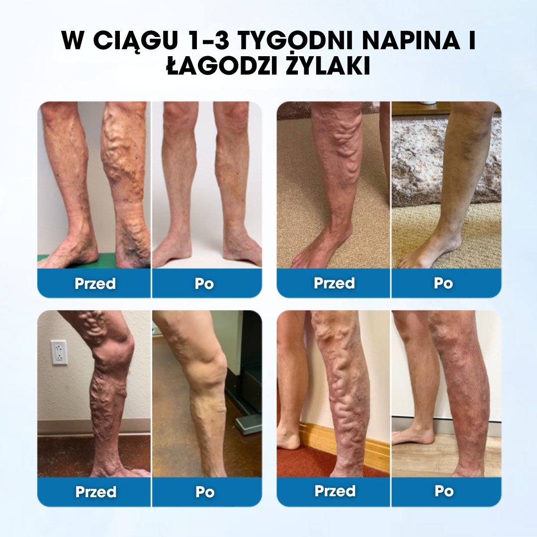 Timilk® VeinGuard – Klinicznie potwierdzona skuteczność w redukcji żylaków