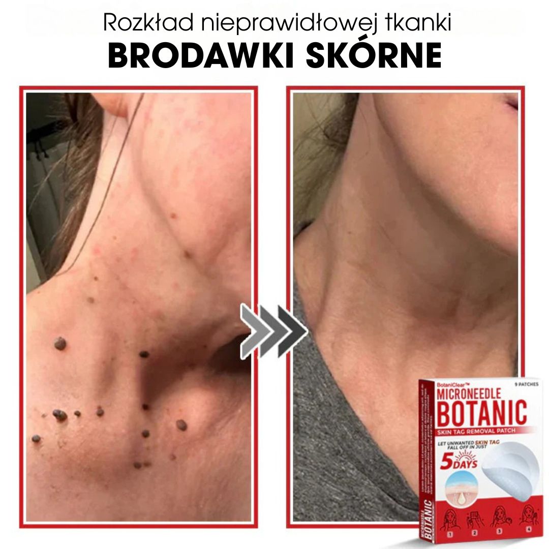 BotaniClear™ – Plaster z mikronakłuciami na zmiany skórne - 1+1 GRATIS