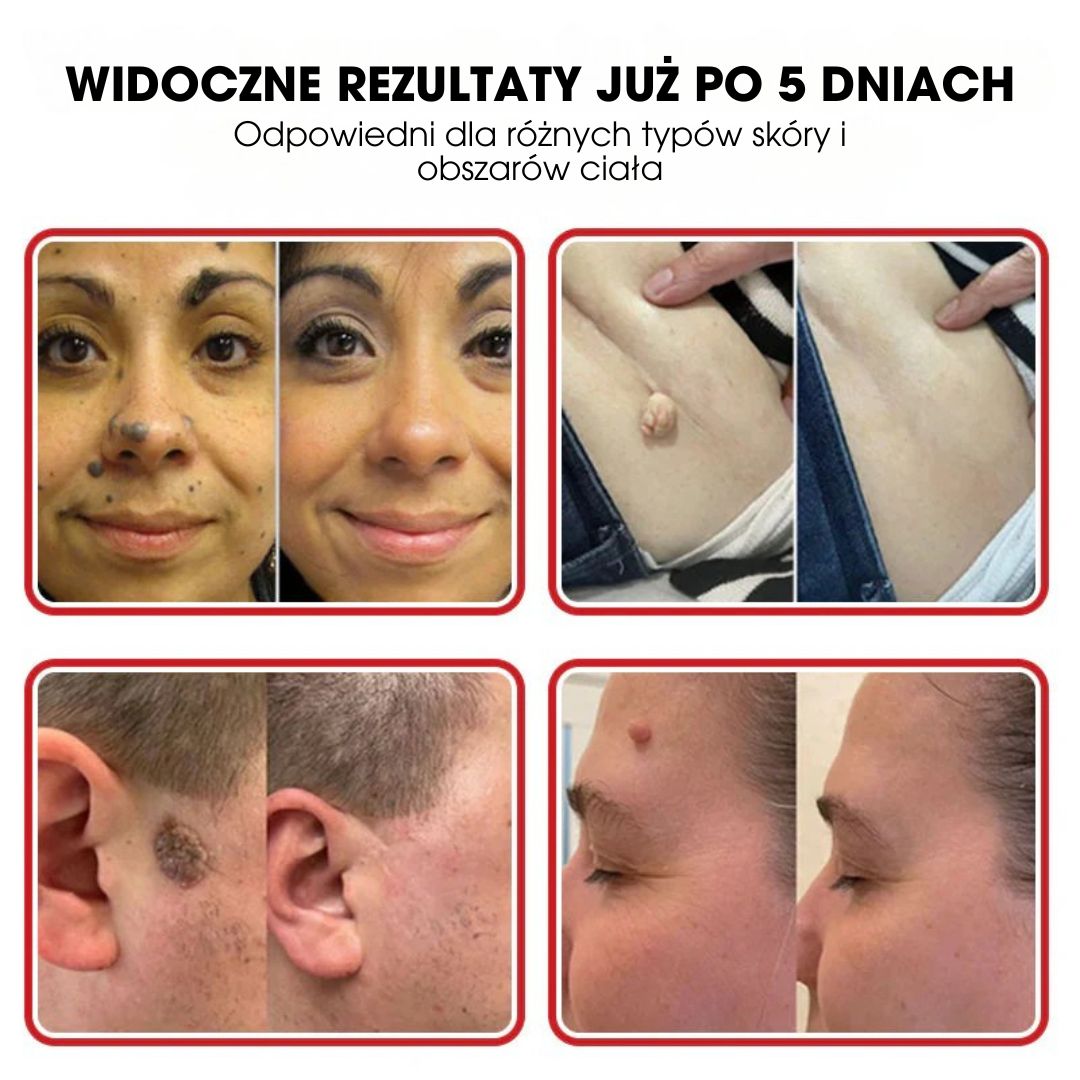 BotaniClear™ – Plaster z mikronakłuciami na zmiany skórne - 1+1 GRATIS