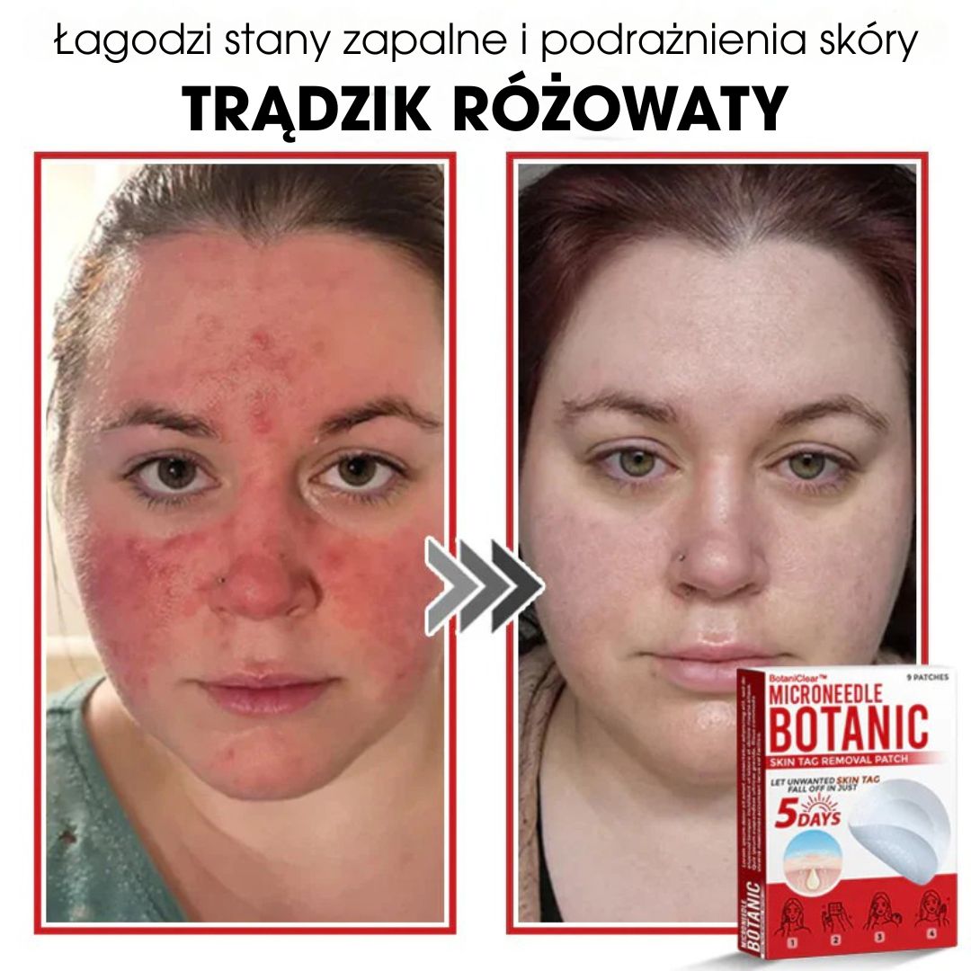 BotaniClear™ – Plaster z mikronakłuciami na zmiany skórne - 1+1 GRATIS